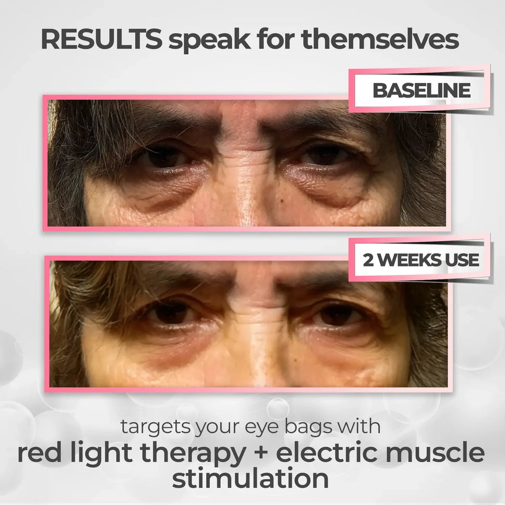 RevitalEyes® 2-in-1 Red Light Therapy + EMS To Erase Eye Bags